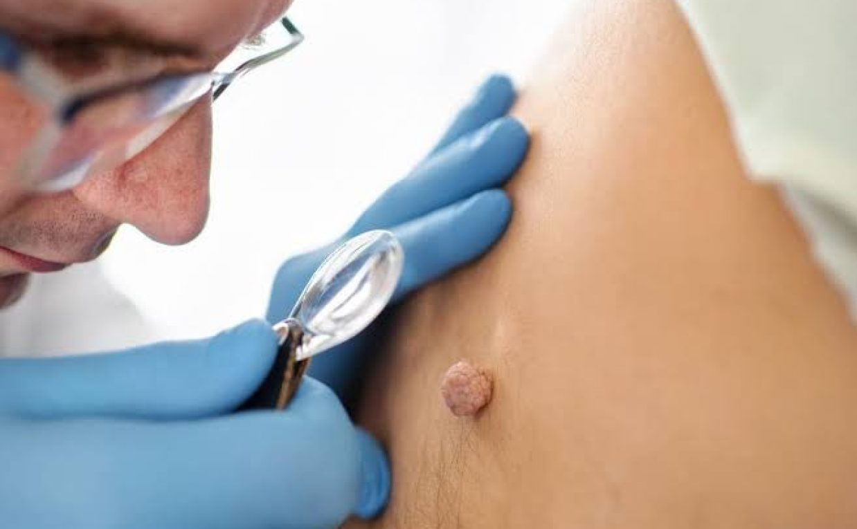 Is Skin Tag Removal Recommended for Common Skin Tags?