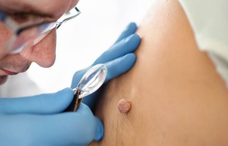 Is Skin Tag Removal Recommended for Common Skin Tags?