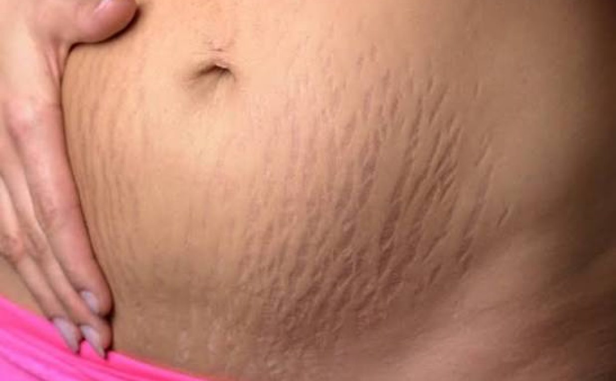 Does Stretch Marks Removal Address Old Marks?
