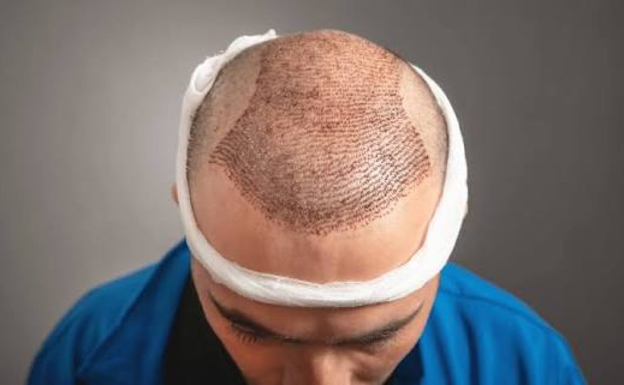 Is Fue Hair Transplant Suitable for Hair Loss?