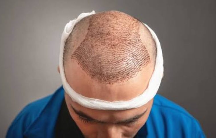 Is Fue Hair Transplant Suitable for Hair Loss?