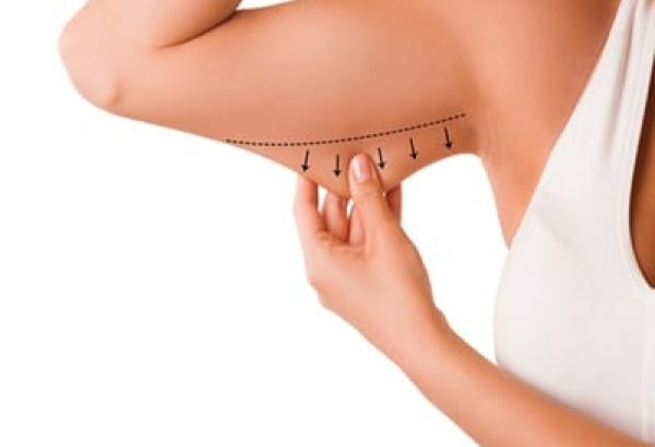 Does Arm Lift Surgery Help Reduce Excess Arm Fat?