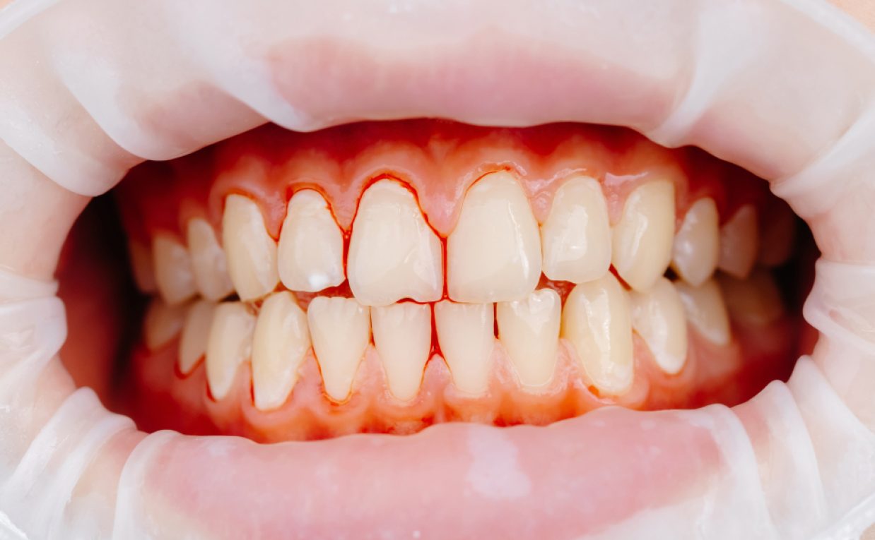 Can Gum Recession Treatment Restore Exposed Tooth Roots?