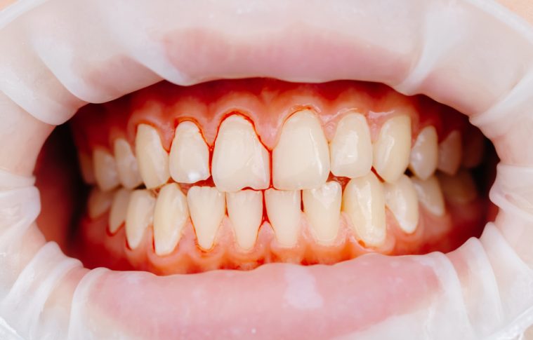 Can Gum Recession Treatment Restore Exposed Tooth Roots?