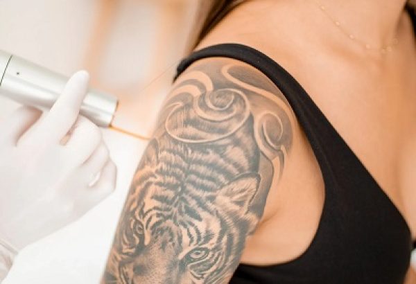 Can Laser Remove Colored Tattoos?