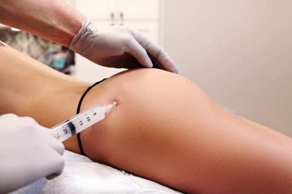 What Should You Know Before Choosing Butt Fillers?
