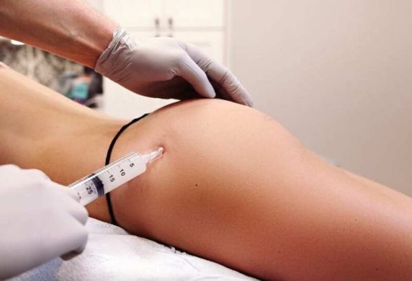 What Should You Know Before Choosing Butt Fillers?