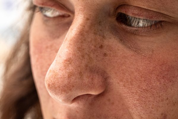 Can Best Pigmentation Treatment Improve the Look of Mature Skin?