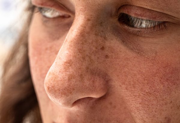 Can Best Pigmentation Treatment Improve the Look of Mature Skin?