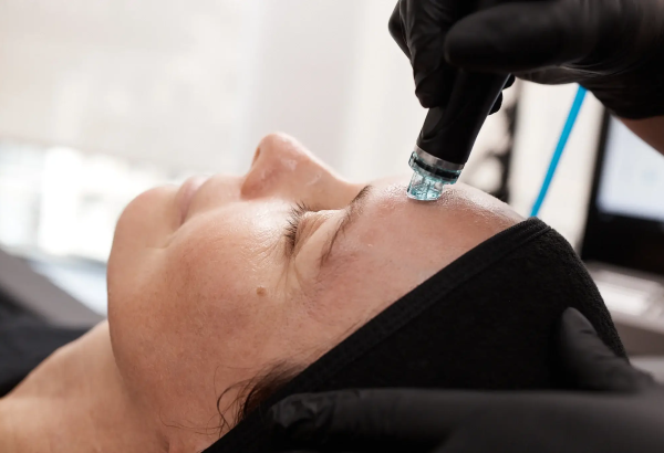 Can Hydrafacial Improve the Look of Fine Lines After 30?