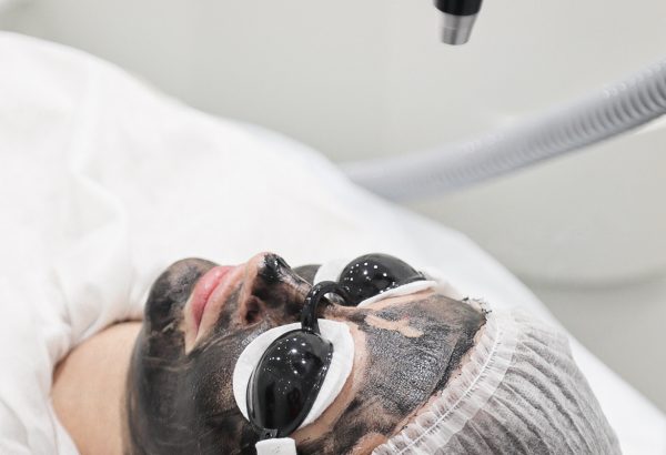 Can Laser Carbon Peels Help With Blackheads?