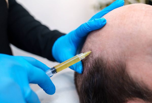 Can PRP Hair Treatment Improve Hairline Thickness?