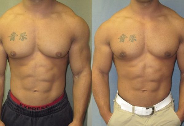 When Can Men Exercise After Gyno Surgery Dubai?
