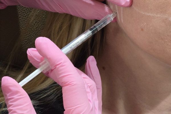 Is Nefertiti Lift Suitable for Mild Neck Aging?