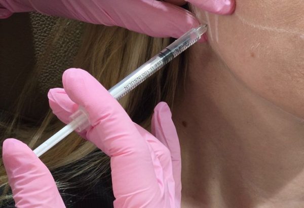 Is Nefertiti Lift Suitable for Mild Neck Aging?