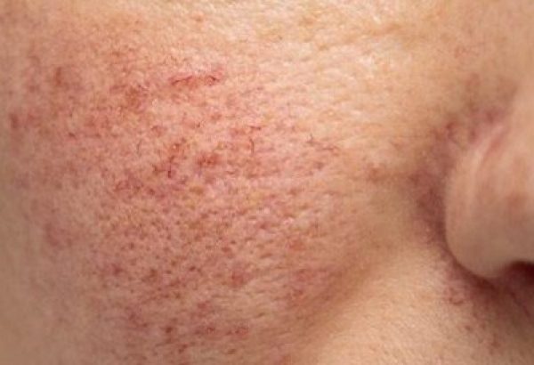Is Rosacea Treatment Appropriate for Every Skin Type?