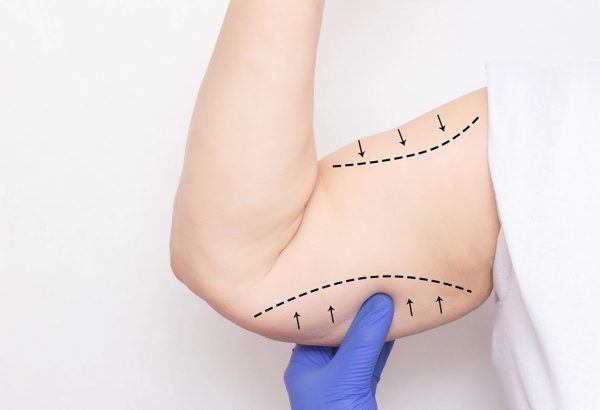 Can Arm Lift Surgery Help After Massive Weight Loss?