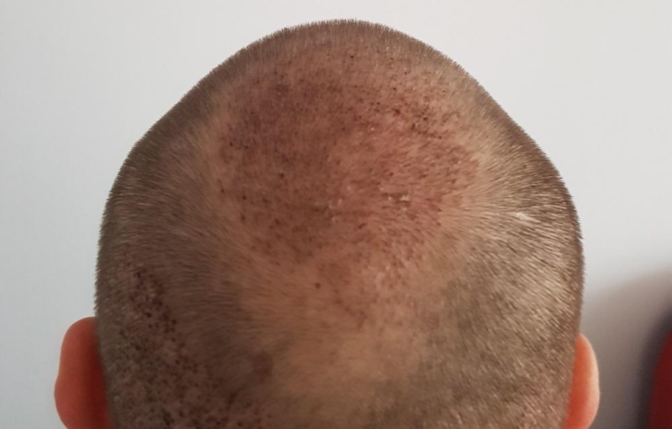 Who Should Avoid Crown Hair Transplants?