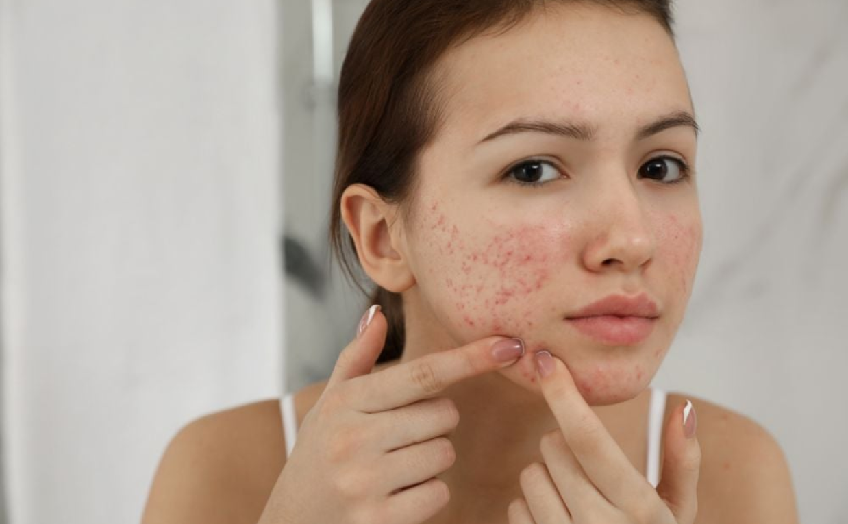 Best Acne Treatment for Acne-Prone Oily Skin