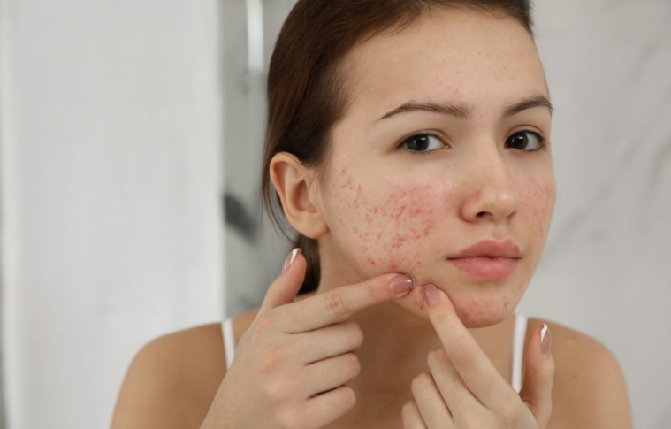 Best Acne Treatment for Acne-Prone Oily Skin