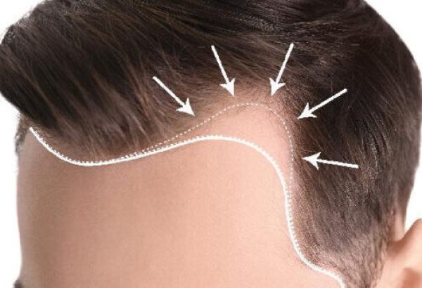 Can a Hair Transplant Restore a Receding Hairline?