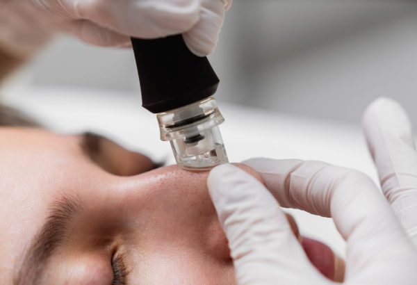 Does Hydrafacial Reduce Blackheads?