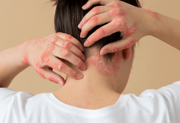 Which Skin Disease Treatments Are Most Effective?