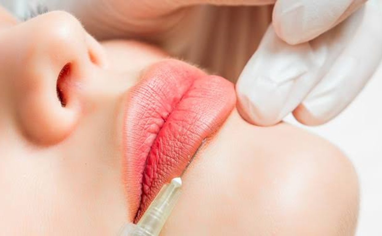 How Lip Augmentation Improves Lip Definition