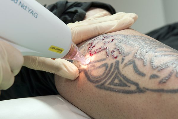 Can Adults Over 40 Consider Laser Tattoo Removal?