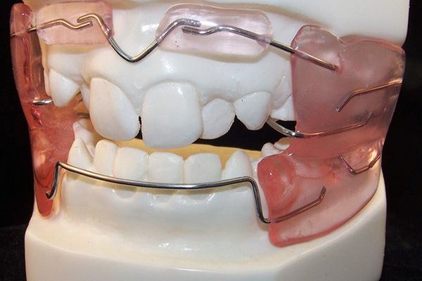 How Do Dental Activators Support Better Jaw Growth?