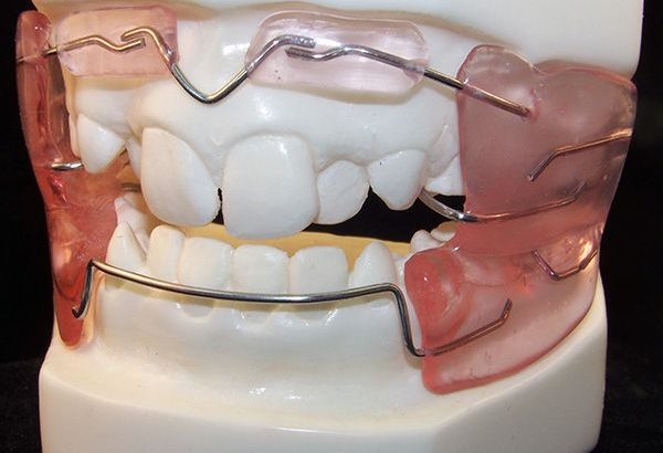 How Do Dental Activators Support Better Jaw Growth?