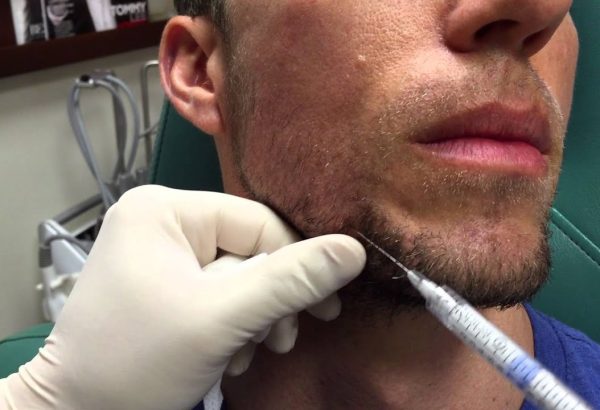 Does the Filler Brand Change the Best Jawline Fillers Price?