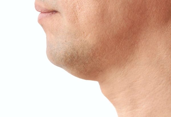 How Do You Know if Double Chin Liposuction Is Right for You?