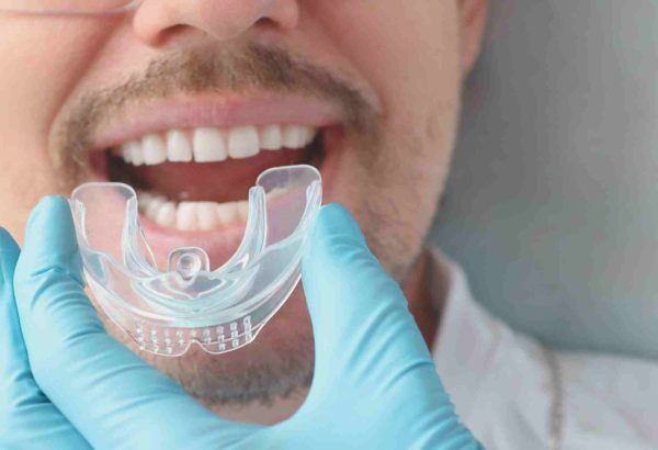 What Are Mouth Guards and Do You Really Need One Today?