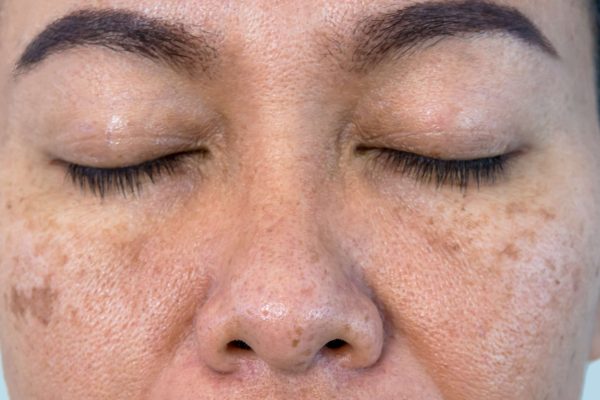 What Is Included in Melasma Treatment Cost?