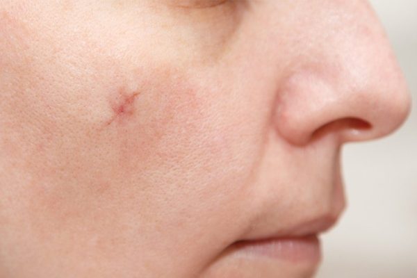 What Should You Know Before Choosing Surgical Scar Revision?