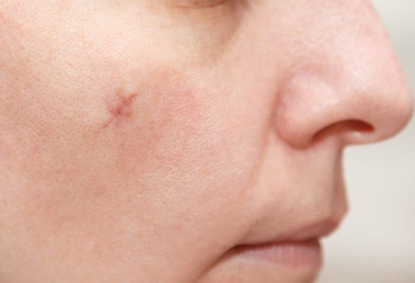 What Should You Know Before Choosing Surgical Scar Revision?