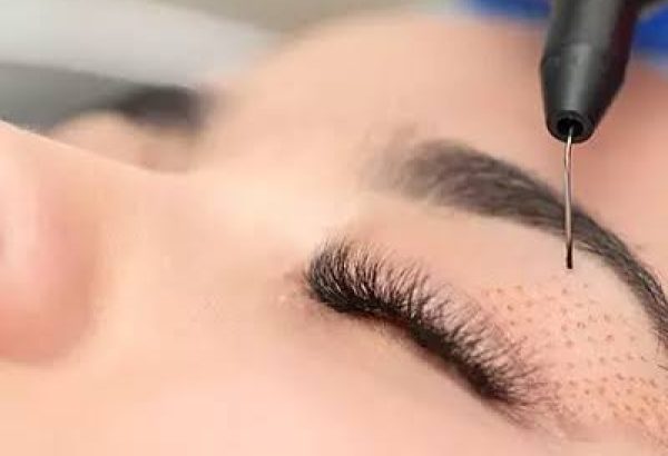 Does Plexr Plasma Eye Lift Improve Eye Appearance?