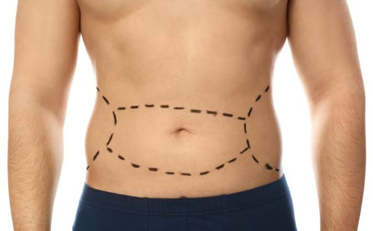 What Concerns Can a Tummy Tuck Address?