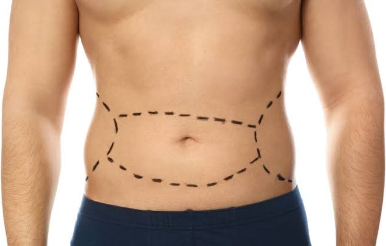 What Concerns Can a Tummy Tuck Address?