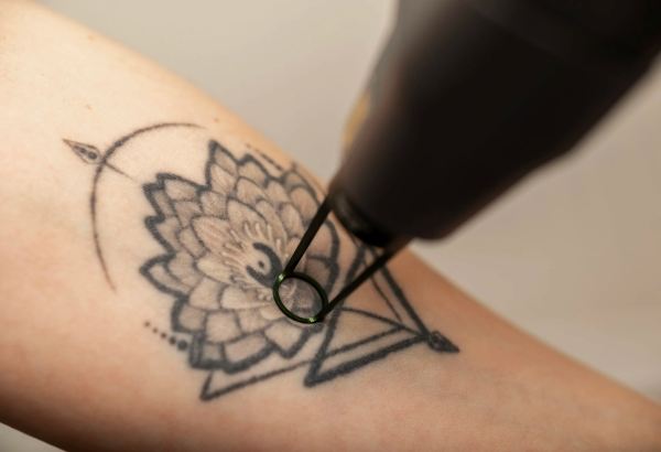 What Should You Look for in a PicoSure Tattoo Removal Clinic?