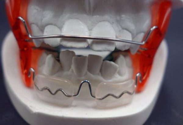 What Are Dental Activators and How Do They Work?