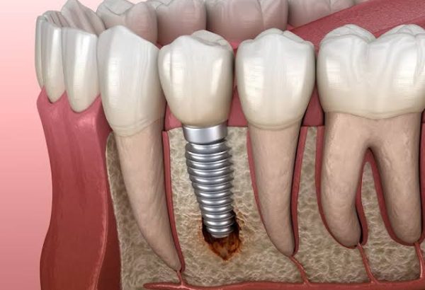 What Are the Early Signs of a Dental Implant Infection?