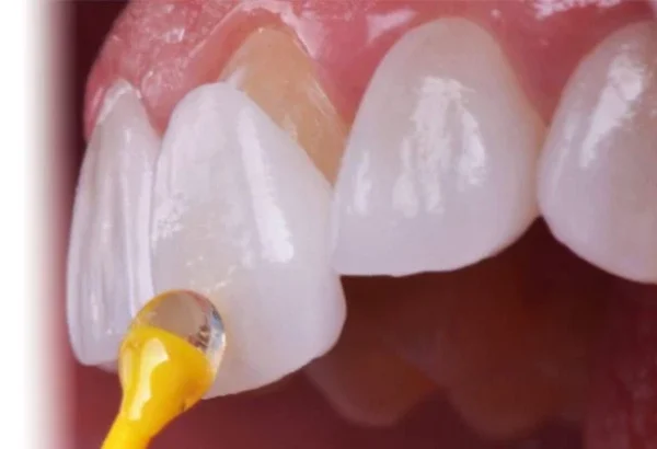 Why Is Professional Teeth Cleaning Important for Oral Health?