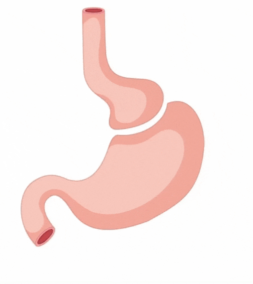 How Does Mini Gastric Bypass Help With Long-Term Weight Loss?