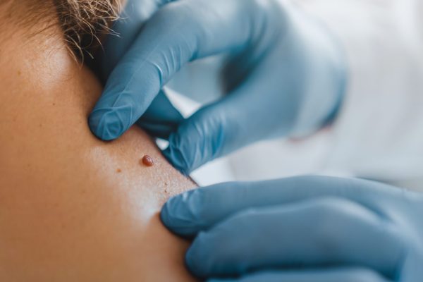 What Happens During a Professional Wart Removal Session?