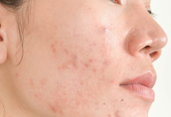 Why Is Acne Treatment Important for Healthy-Looking Skin?