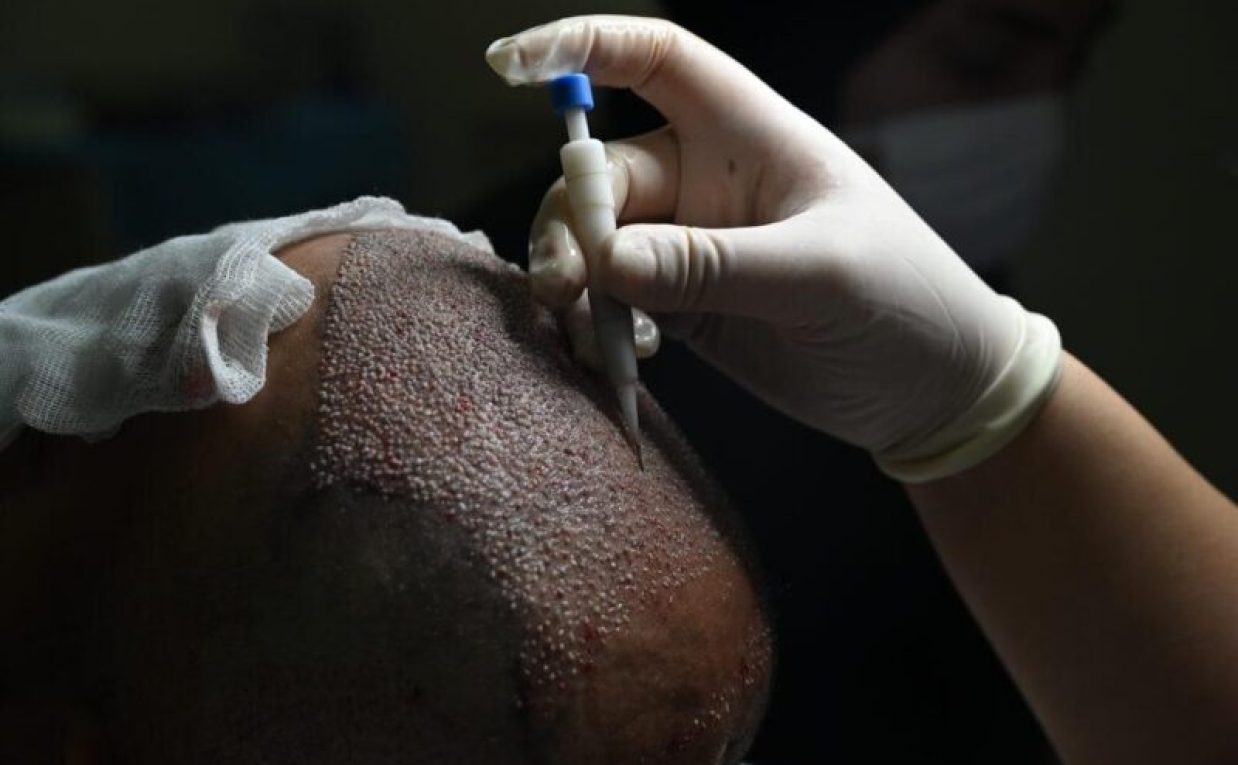 Can Previous Hair Treatments Affect Hair Transplant Cost?