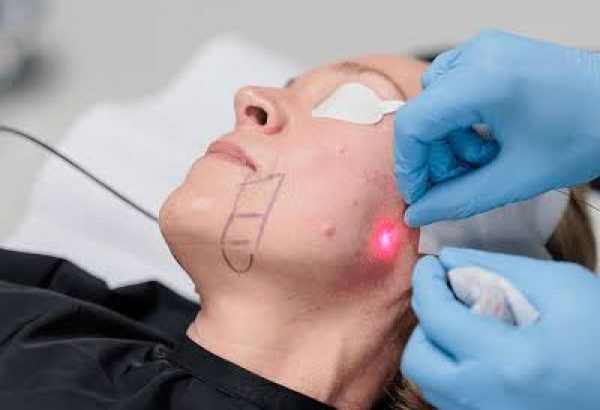What Happens During Endolift Treatment?