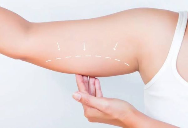 What Are the Main Benefits of Arm Lift Surgery Procedures?